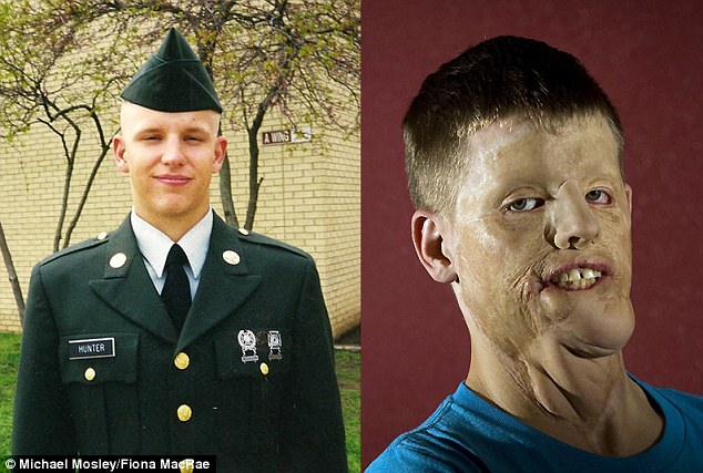 美国小伙为救人惨遭毁容 接受全脸移植获新生