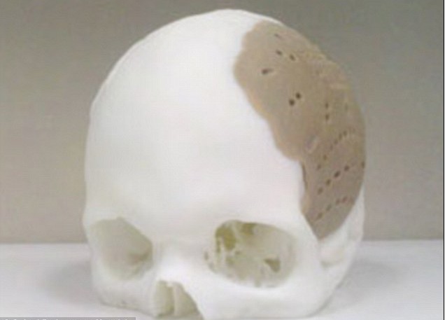 头骨也能打印!美公司用3D打印技术造福移植患