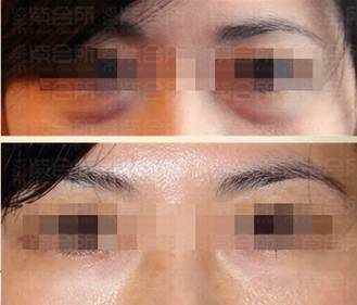 紫会所美塑枪轻松抗衰老