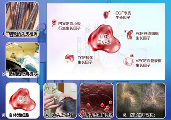 科发源的新传奇:ST自体活细胞应用