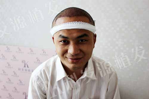 张青松:我之最 一次植发三种技术