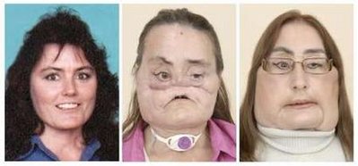 美“捐脸”妇女身份揭开 受益者与其家人见面