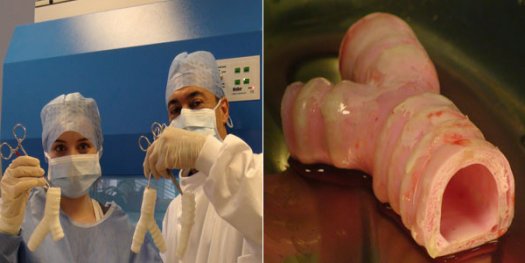 医学界新突破：瑞典完成世界首例人造器官移植