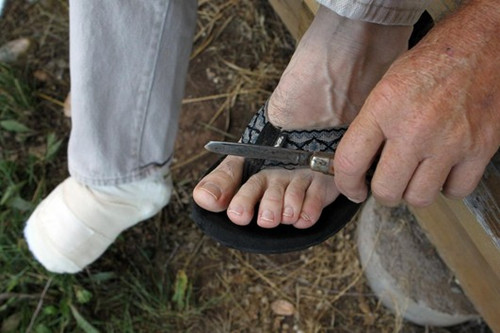 美男子遭70吨重拖车压住脚 自切5脚趾保命(图)