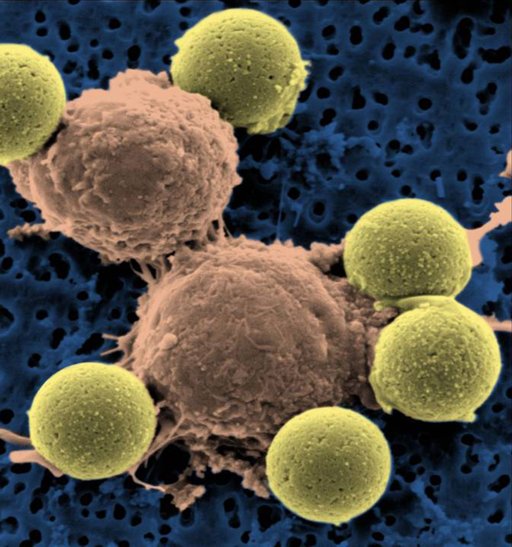 美科学家用HIV病毒治疗白血病初试成功 为人类攻克癌症带来曙光(环球周末)