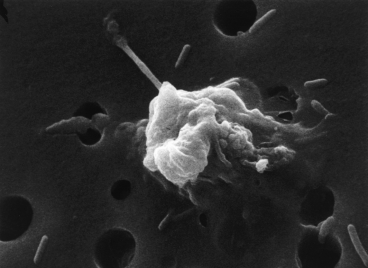 一个癌细胞在一种蛋白质的作用下走向死亡