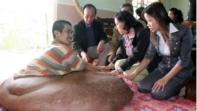 越南男子腿部长有90公斤巨瘤 医生免费为其摘