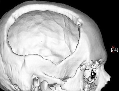 英国高超整容手术令人惊叹 用腹部脂肪填补头上凹坑