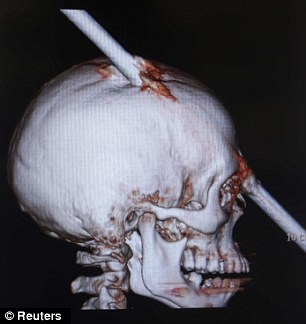 铁棒刺进后脑从双眼间穿出 巴西小伙奇迹生还不觉疼