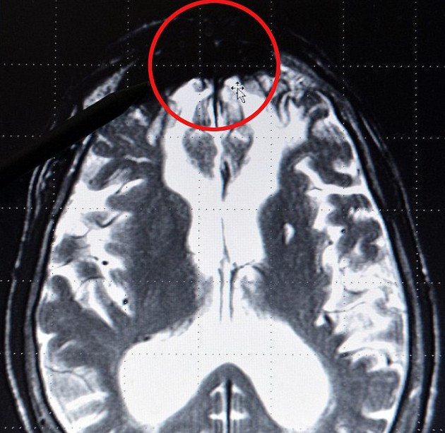 德國專家揭秘罪犯大腦結構：邪惡黑影潛伏特定區域