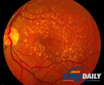美国公司干细胞疗法见奇效 一盲人受试者重见光明
