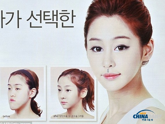 嘴部整形手术风靡韩国 旨在打造迷人微笑弧度