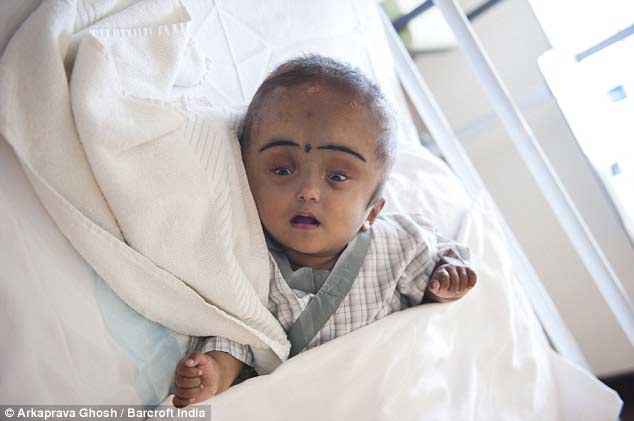 印度大头女婴接受头骨矫正术 头围缩小到正常