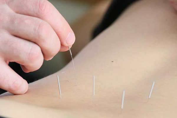 Chinese acupuncture thrives in Lithuania