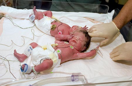 This handout picture shows conjoined twins, Krista (bottom) and Tatiana Hogan, at the BC's Women's Hospital and Health Centre in Vancouver, British Columbia, October 26, 2006. The twin girls joined at the head are doing well a day after their birth, but doctors said on Thursday it could be three or four months before they will know if they can be separated. 
