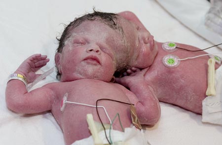 This hand-out photo shows conjoined twins Tatiana (L) and Krista Hogan sleeping in Vancouver, British Columbia, October 26, 2006. The twin girls joined at the head are doing well a day after their birth, but doctors said on Thursday it could be three or four months before they will know if they can be separated.