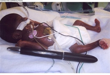 Just a few days old, Amillia Taylor is shown lying next to a ballpoint pen to show her tiny size. Amillia is the world's youngest gestational-age baby, born at 21 weeks and six days on Oct. 24, 2006. Weighing less than ten ounces and measuring only 9.5 inches in length, she is also the fourth smallest baby in the world to survive. Baby Amillia will be going home after four months in the NICU at Baptist Children's Hospital in Miami, FL. (Photo: Business Wire) 