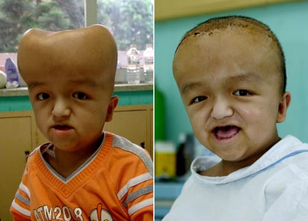 A combo picture shows Liu Jing before and after a surgery to reconstruct his deformed skull at a hospital in Xiamen, East China's Fujian Province, August 2, 2007. Liu Jing, 9, suffering from hydrocephalus at his birth and later the deformed skull, received a 13-hour surgery on July 15, 2007. [Xinhua]