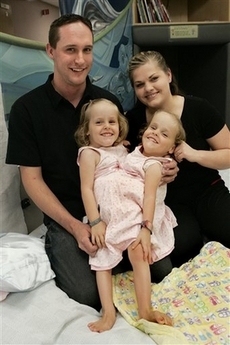 Four-year-old conjoined twins to undergo separation