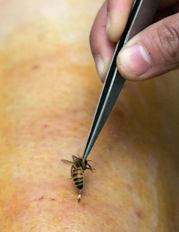 Bee venom used in medical treatment