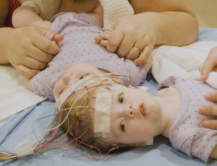 Conjoined twins in Canada