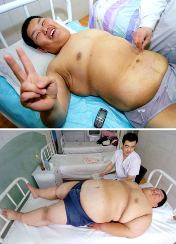 Overweight boy loses 109 kg