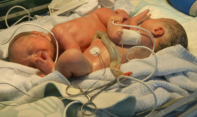 Conjoined twins separated successfully
