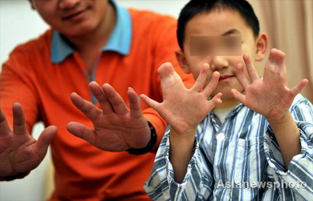 Boy with 31 fingers and toes ready for operation