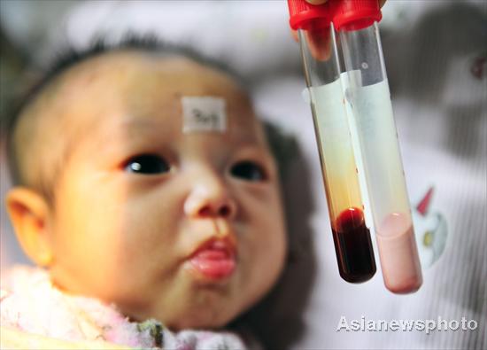 Rare case of baby with pink blood