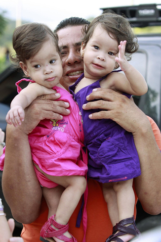 Conjoined twins celebrate 1st birthday