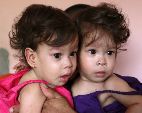 Conjoined twins celebrate 1st birthday
