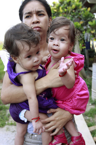 Conjoined twins celebrate 1st birthday
