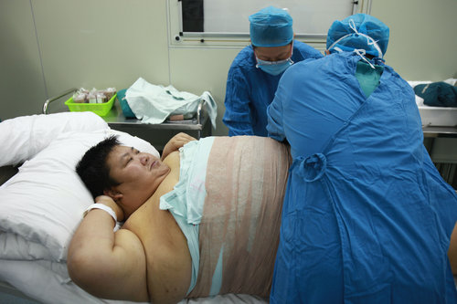 Overweight man gets rid of fat in surgery