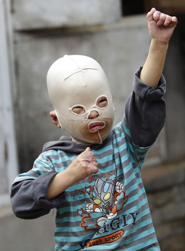 Masked boy barred from kindergarten due to burns