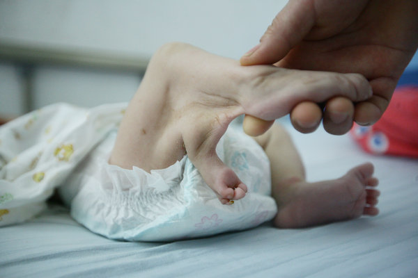 Infant with three legs abandoned in E China