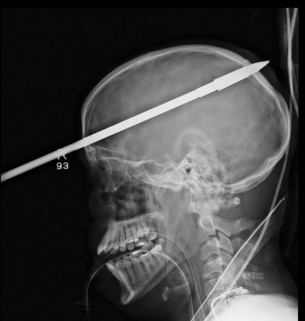 Teen recovering after he's shot in head with spear