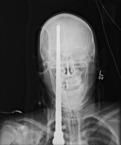 Teen recovering after he's shot in head with spear