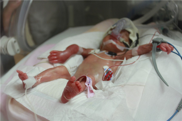 Palm-size baby born in C China