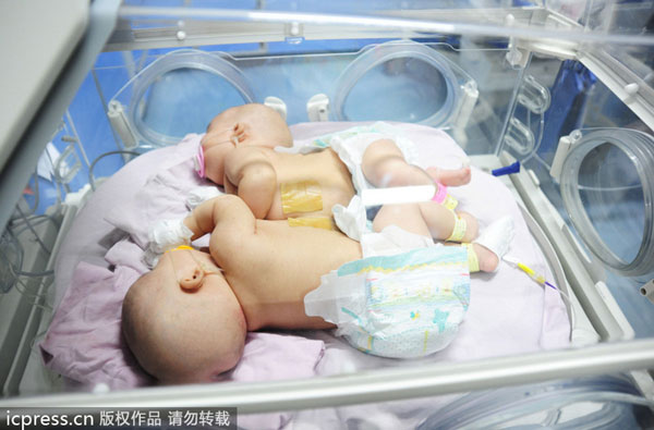 Conjoined babies separated in E China