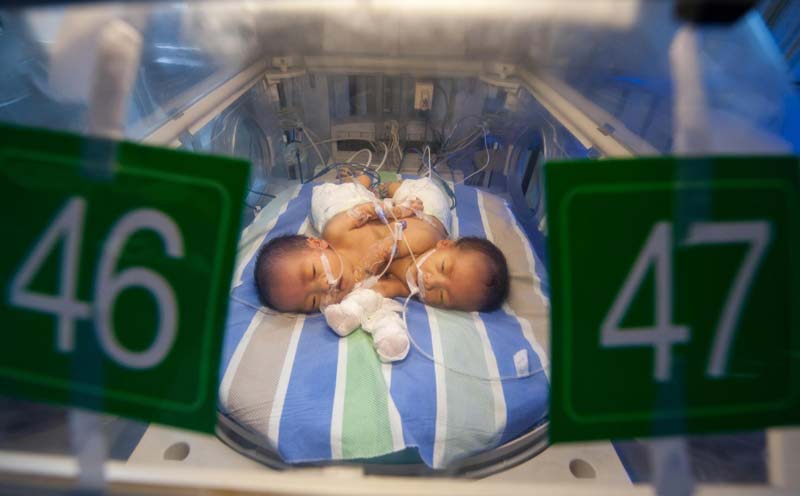 Doctors consider separating conjoined twins