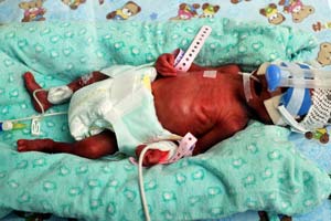 Doctors consider separating conjoined twins