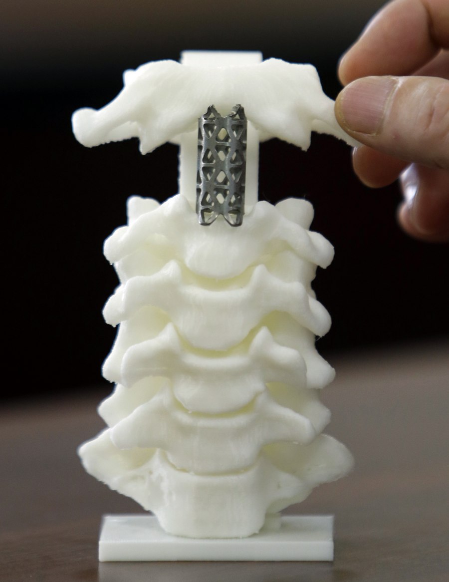 First 3D-printed artificial axis in China