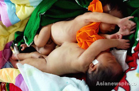 Conjoined twins born in Central China
