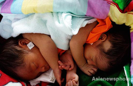 Conjoined twins born in Central China