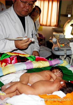 Conjoined twins born in Central China