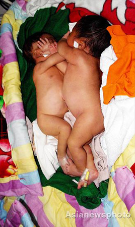 Conjoined twins born in Central China