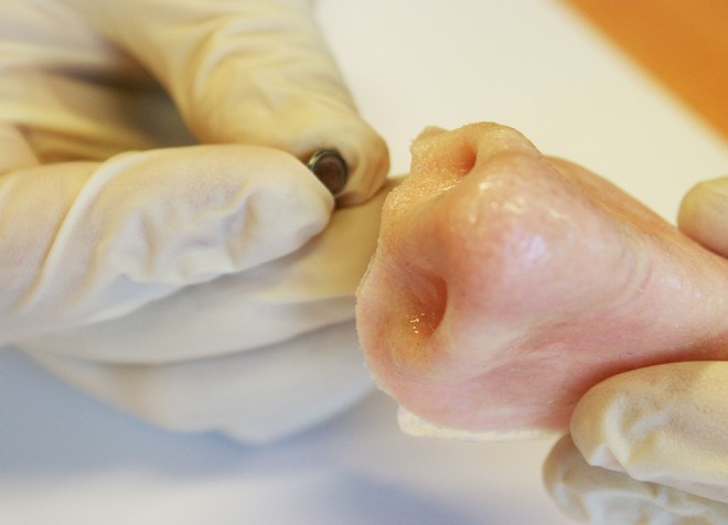 外部创伤患者福音：3-D打印鼻子、耳朵诞生