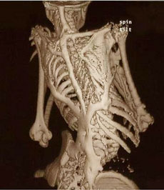 In this handout photo provided by the University of Pennsylvania, a CAT scan showing the back of an unnamed 12-year-old patient of Dr. Frederick Kaplan, showing bone formation typical of FOP, is shown. Scientists have discovered a mutant gene that triggers the body to form a second, renegade skeleton, solving the mystery of a rare disease called FOP that imprisons children in bone for life. The finding, reported Sunday, may one day lead to development of a drug, not only to treat the rare bone disorder, but more common bone buildup related to head and spine trauma, and even sports injuries, the researchers said. (AP 