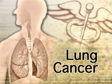 A controversial new study reported in Thursday's New England Journal of Medicine offers the strongest evidence yet that screening smokers for lung cancer with computerized chest scans can save lives. (AP 