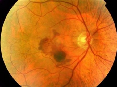 A photograph released to Reuters on November 8, 2006 from Moorfields Eye Hospital in London. The image shows the back of the eye in a patient with age-related macular degeneration shows blood and degeneration in the central part of the retina. The circle to the right is the optic nerve, corresponding to the blind spot. The retina is lined with millions of light sensitive photoreceptor cells. 